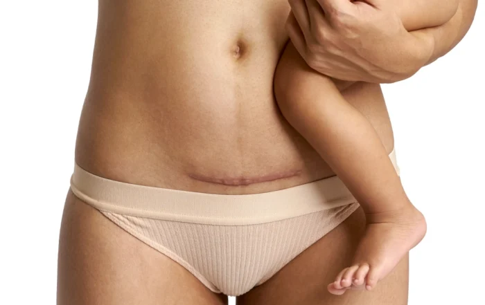 C Section Scar