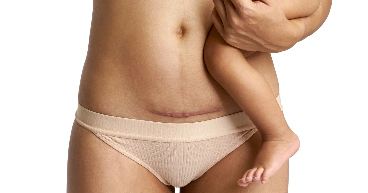 C Section Scar